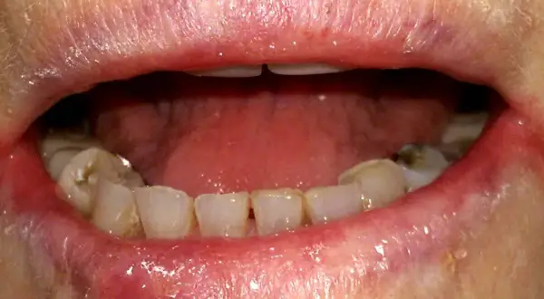Labbra arrossate e screpolate, con segni di cheilite angolare agli angoli della bocca. Denti visibili, alcuni con macchie.
