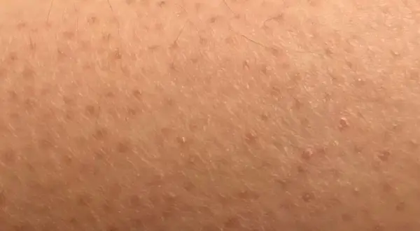 Pelle con cheratosi pilare, piccoli puntini rossi e peli incarniti. Scopri come curarla.