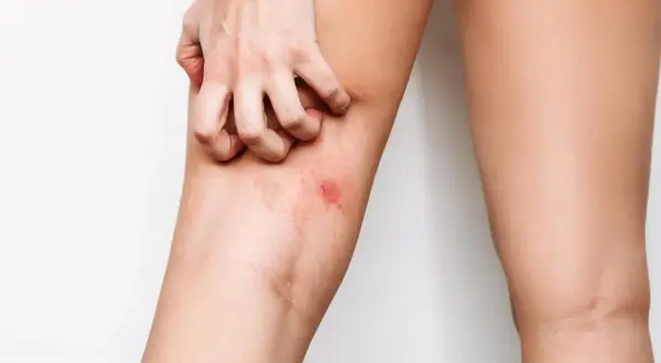 Mano che si gratta la coscia irritata, cercando rimedi naturali per lo sfregamento cosce.