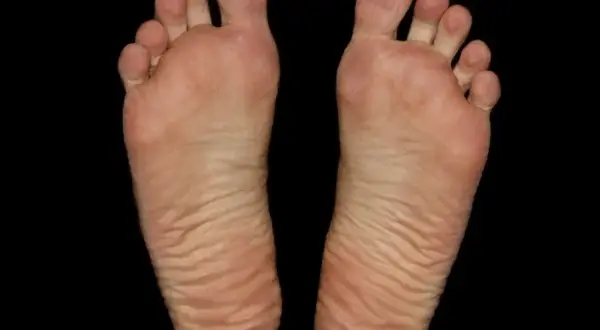 Piante dei piedi con dita separate e pelle rugosa, un segno di camminate lunghe, forse un occhio di pernice in formazione.