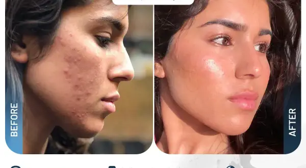Prima e dopo laser CO2: pelle con acne trasformata in viso luminoso e senza imperfezioni.
