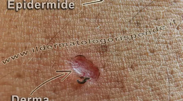 Ingrandimento della pelle che mostra l'epidermide superficiale e la derma sottostante, con una piccola lesione.