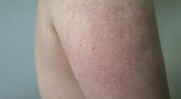 Pelle con follicolite alle gambe, piccoli puntini rossi e peli incarniti. Scopri come curarla per una pelle liscia e sana.