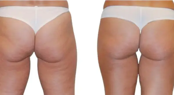 Confronto radiofrequenza glutei prima e dopo: pelle più liscia e tonica.