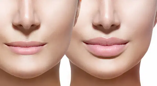 Prima e dopo: labbra più piene e definite, un esempio di come rimpolpare le labbra in modo naturale per un sorriso radioso.