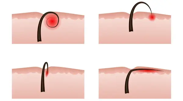 Illustrazione di peli incarniti e infezione cutanea. Diverse fasi di un pelo che cresce sotto la pelle, causando infiammazione e rossore.