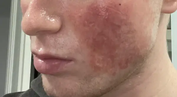 Viso con rossore intenso e pelle lucida dopo trattamento laser CO2 frazionato.