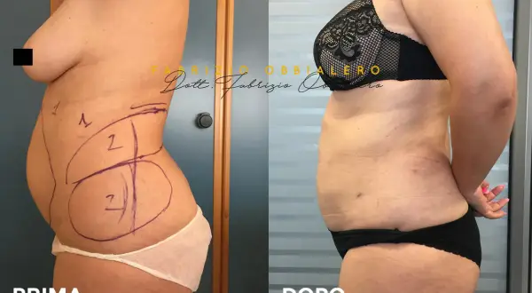 Carbossiterapia pancia prima e dopo: confronto visivo dei risultati. La foto mostra una trasformazione della silhouette.
