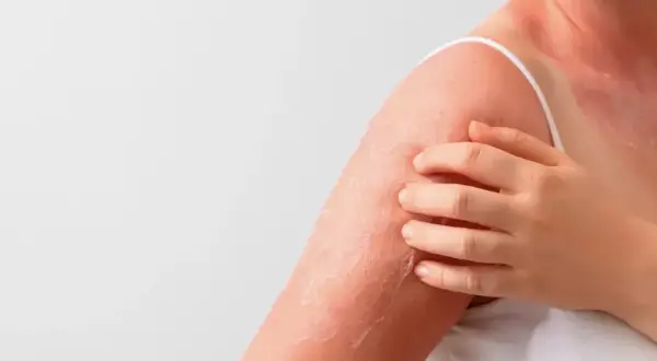 Spalla e collo arrossati con desquamazione, segno di cheratosi della pelle. La mano sfiora la zona irritata.