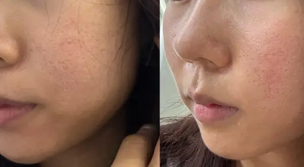 Confronto laser frazionato prima e dopo: pelle con pori dilatati e rossori prima, pelle più liscia e uniforme dopo il trattamento.
