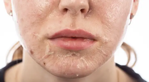 Pelle del viso che si sfalda dopo un trattamento. Il peeling viso cos'è? Un processo di rinnovamento cutaneo.