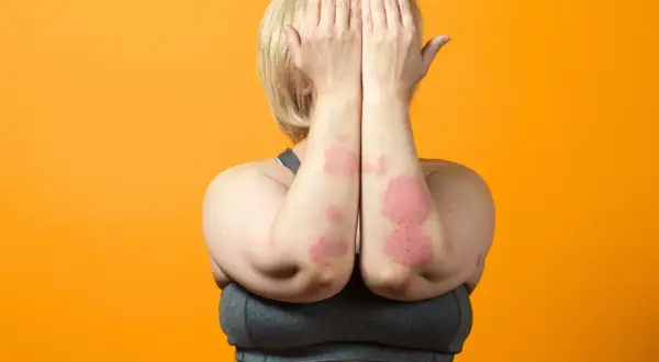 Donna con chiazze rosse sulle braccia, segno di psoriasi da stress. Copre il viso con le mani.