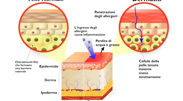 Confronto tra pelle normale e dermatite: la pelle sana ha cheratinociti fitti, mentre la dermatite mostra penetrazione di allergeni, infiammazione e perdita di acqua e grasso.