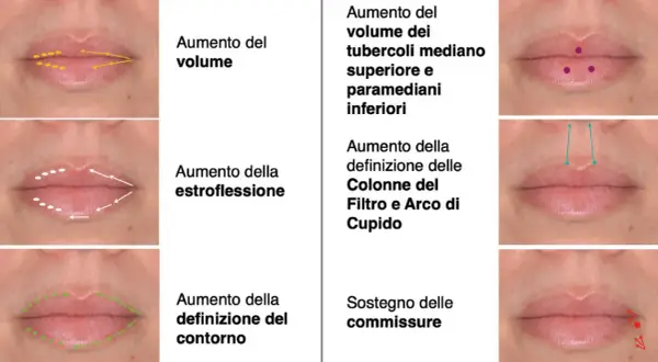 Esempi di filler labbra fatto male: labbra gonfie, asimmetriche o con contorni innaturali. Illustrazioni mostrano correzioni.