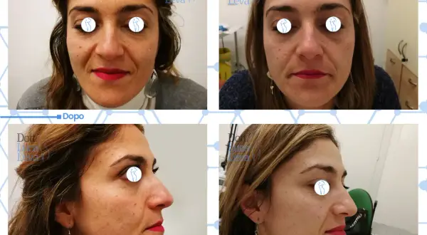 Prima e dopo un trattamento di laser ablativo viso per migliorare la texture della pelle e ridurre le imperfezioni.