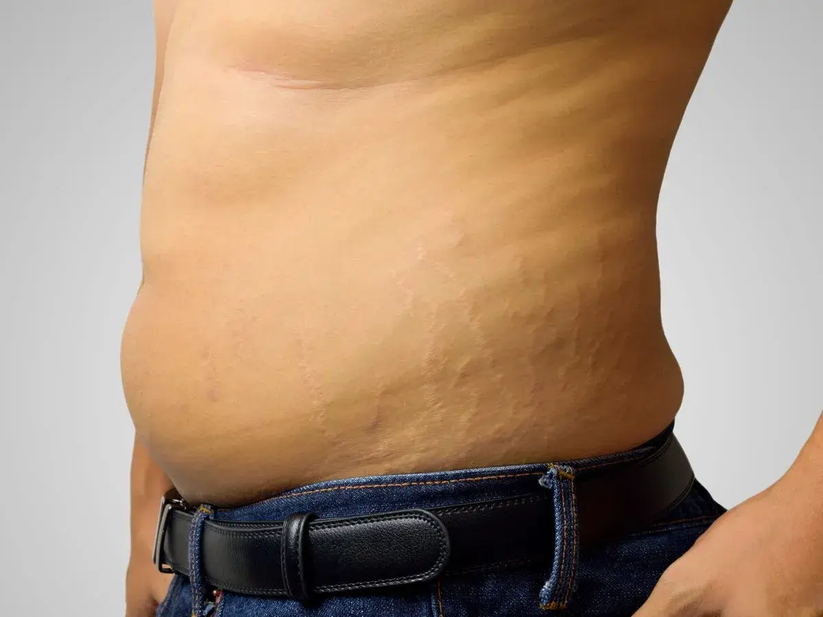 Addome con smagliature, un promemoria che la pelle è un organo che cambia.