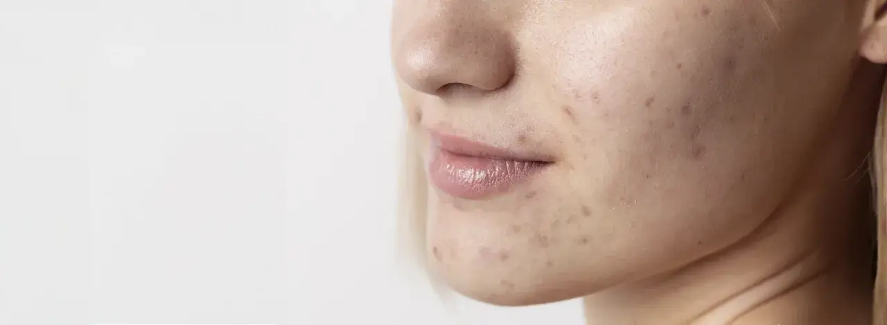 Primo piano del viso di una giovane donna con segni di acne. La pelle mostra imperfezioni, rossori e brufoli, evidenziando la necessità di una **pulizia viso acne**.