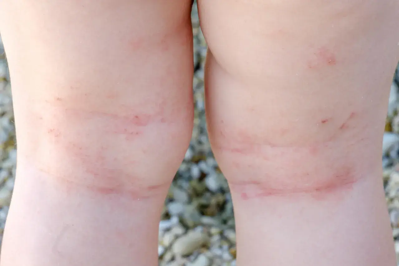 Gambe di bambino con eritema e piccoli puntini rossi, forse dovuti alla sudamina da prurito dopo una giornata al mare.