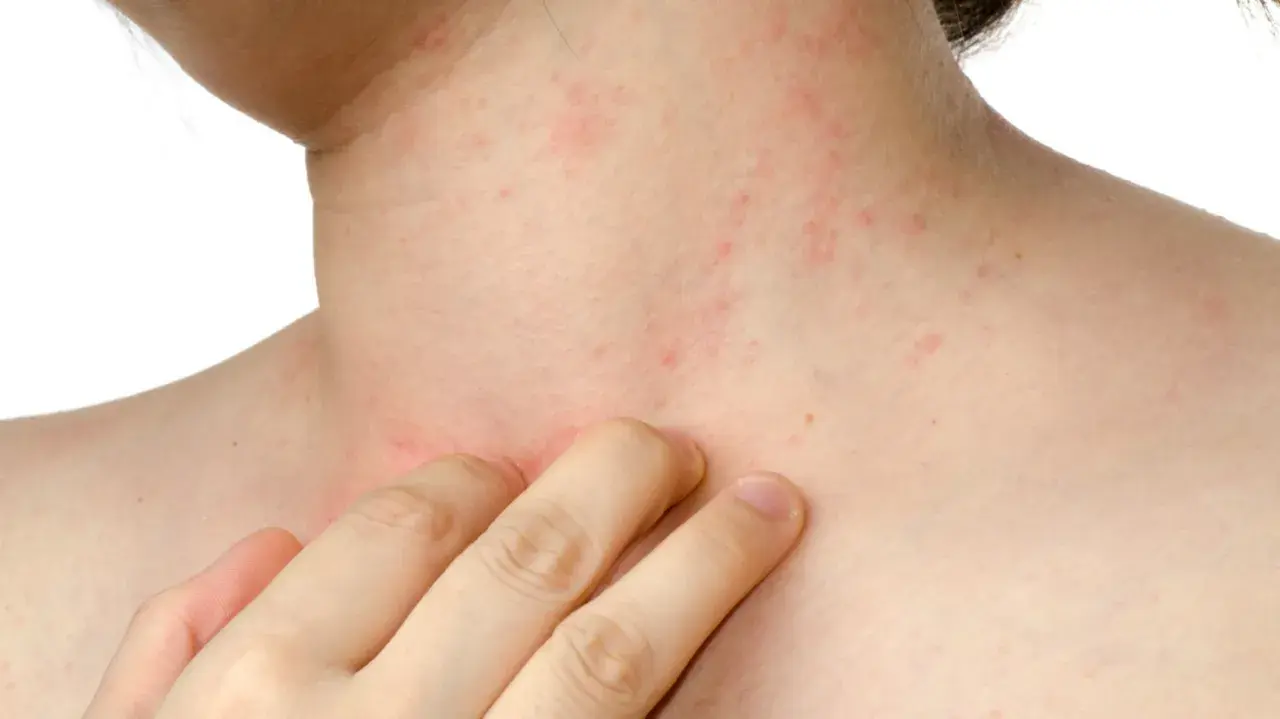 Pelle arrossata e irritata sul collo e sul petto, con piccole macchie rosse, indicative di dermatite da stress.