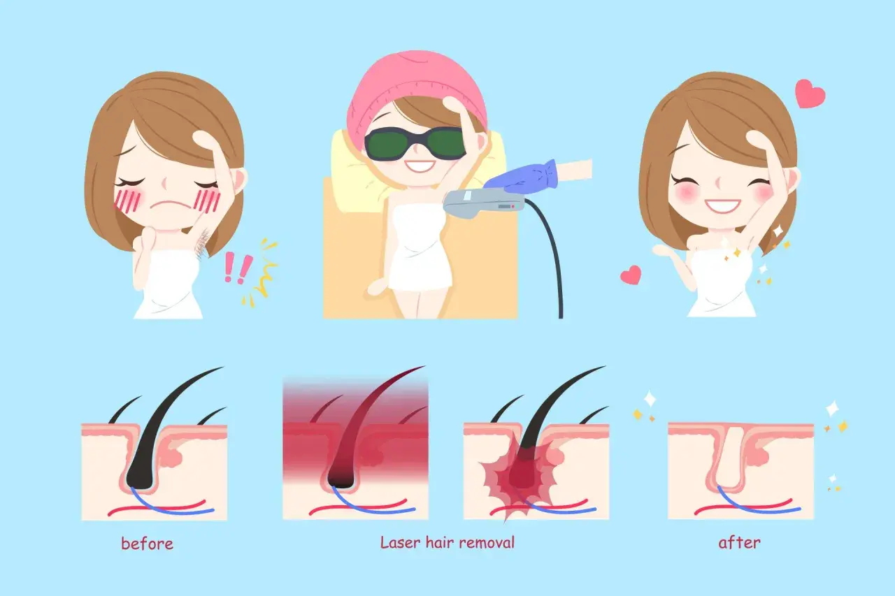Prima e dopo la rimozione peli con laser a diodo. Il trattamento può causare fastidio, ma il risultato è una pelle liscia e senza peli.