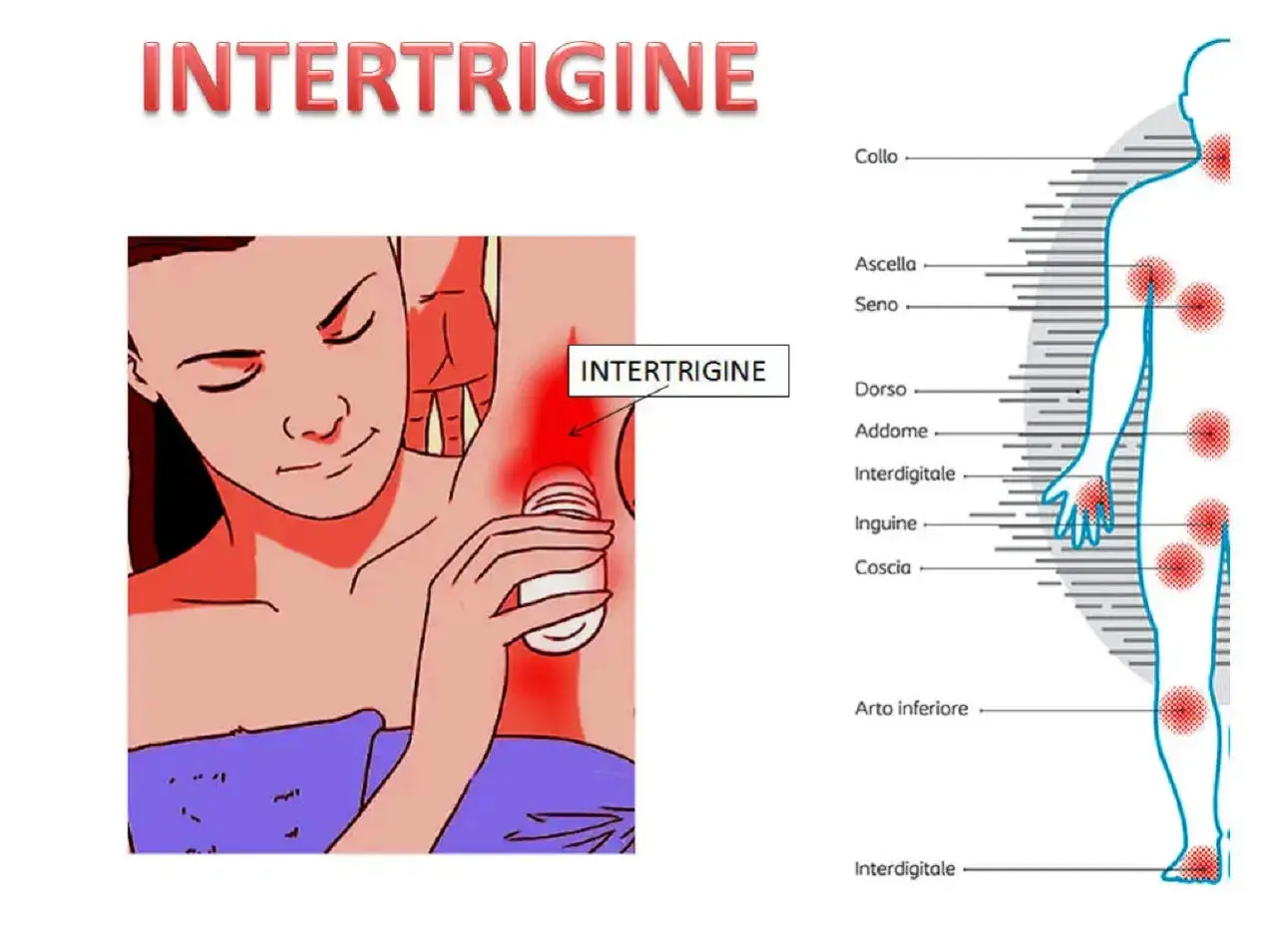 Intertrigine: rossore e puzza sotto il seno e in altre zone del corpo.