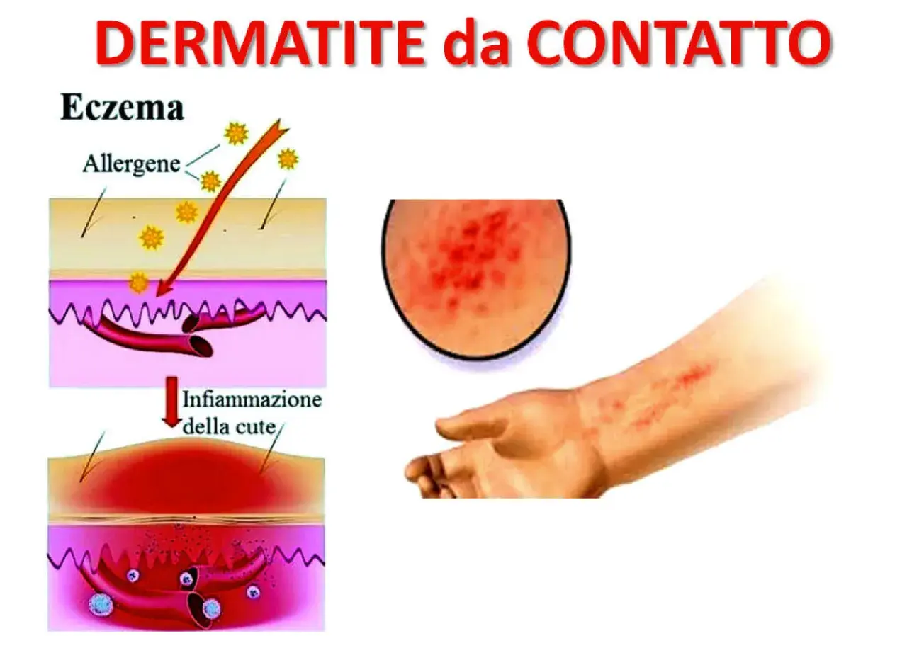 Illustrazione della dermatite da contatto: allergeni penetrano nella pelle causando infiammazione, con un ingrandimento di un'eruzione cutanea e un braccio affetto.