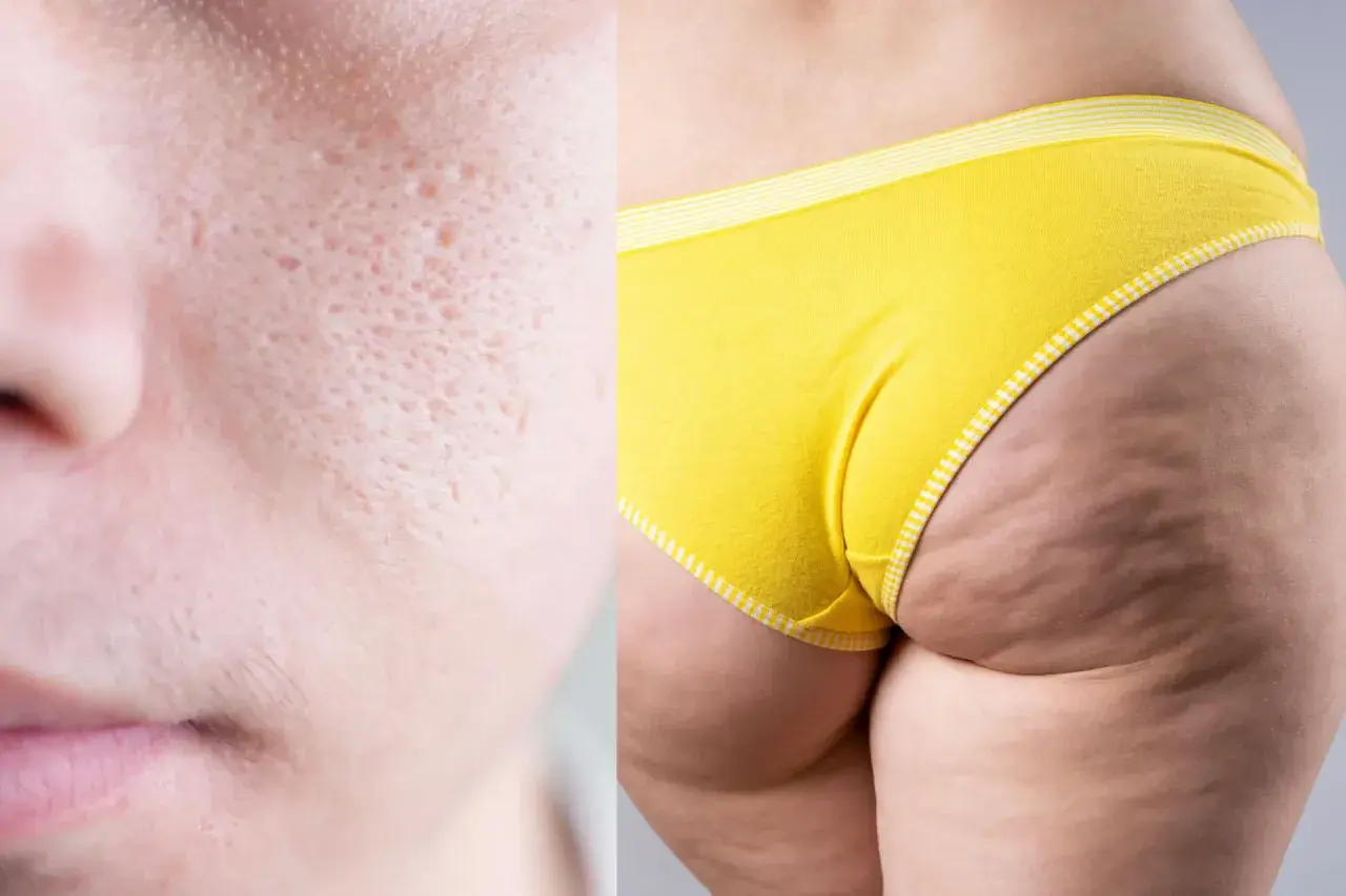 Primo piano di pelle con pori dilatati e cicatrici da acne, affiancato da una coscia con evidente **mento a buccia d'arancia** e culotte gialle.