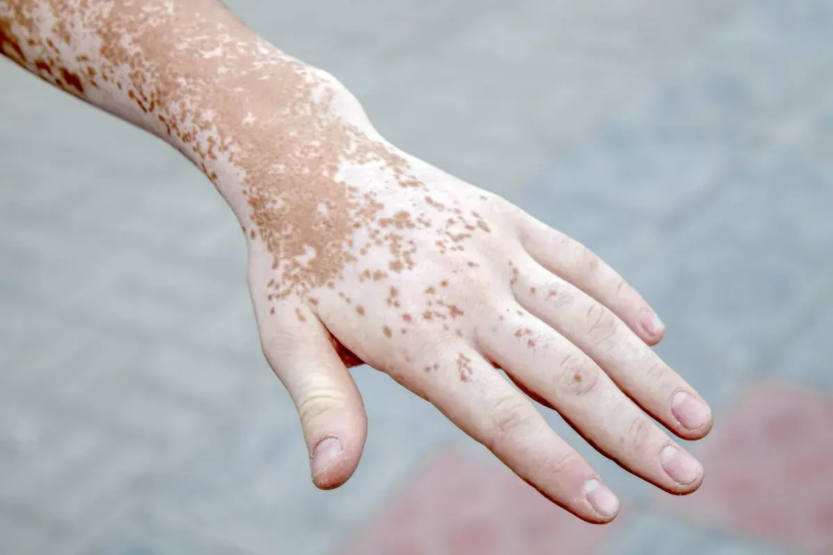 Mano con psoriasi macchie bianche e marroni, un dettaglio della pelle che mostra la vitiligine.