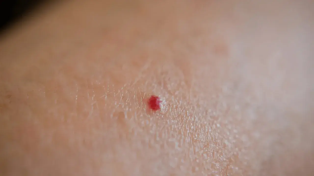 Primo piano della pelle con un piccolo punto rosso, simile a micro bollicine sulla pelle.