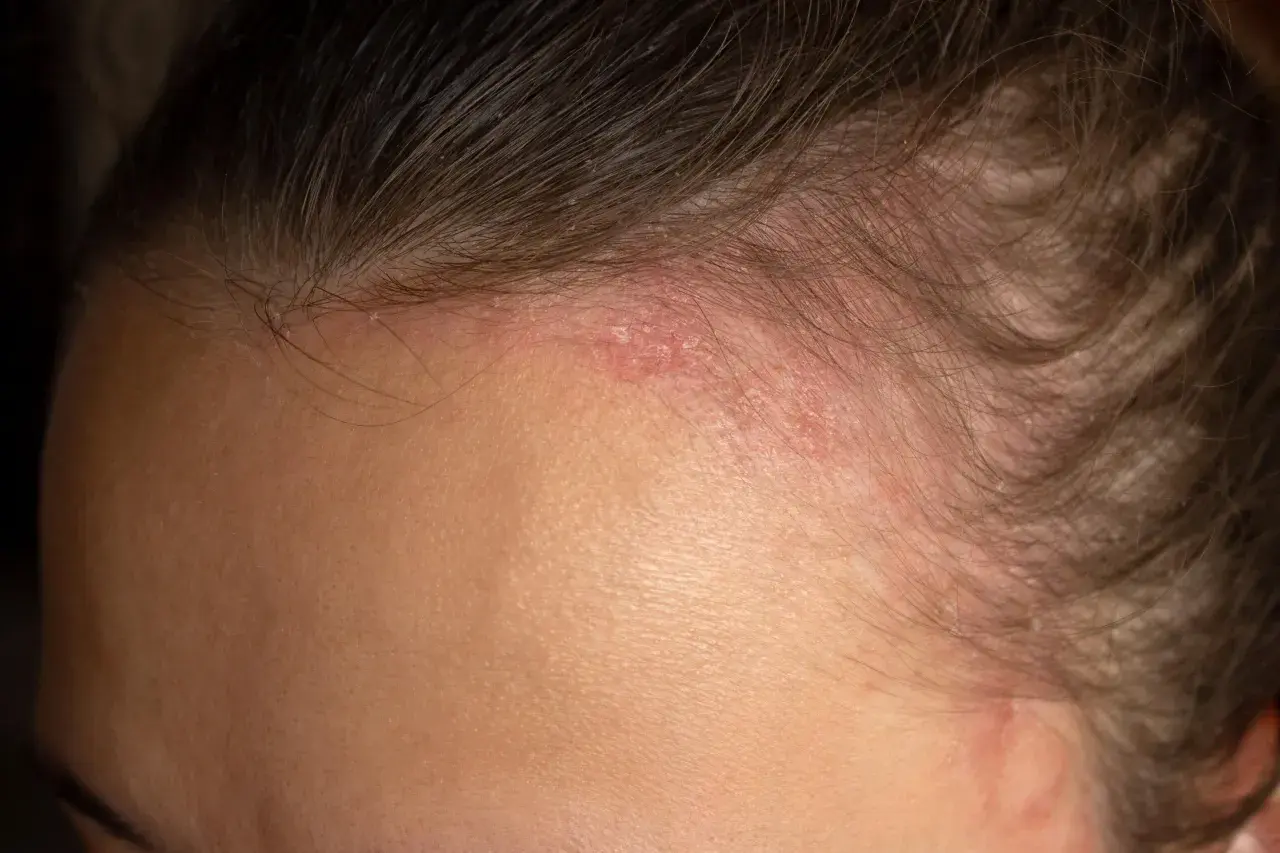 Fronte con arrossamento e squame, tipici della dermatite seborroica. La pelle appare irritata e leggermente desquamata vicino all'attaccatura dei capelli.
