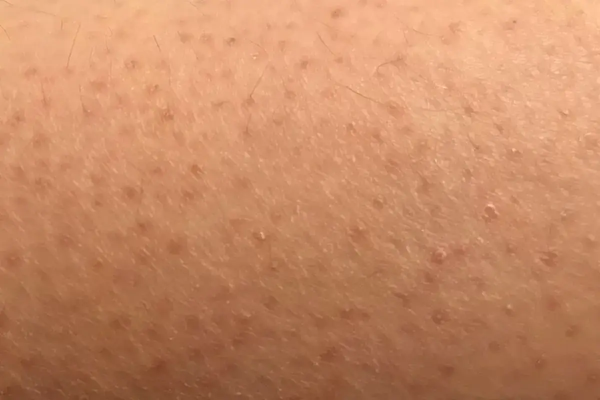 Pelle con cheratosi pilare, piccoli puntini rossi e peli incarniti. Scopri come curarla.