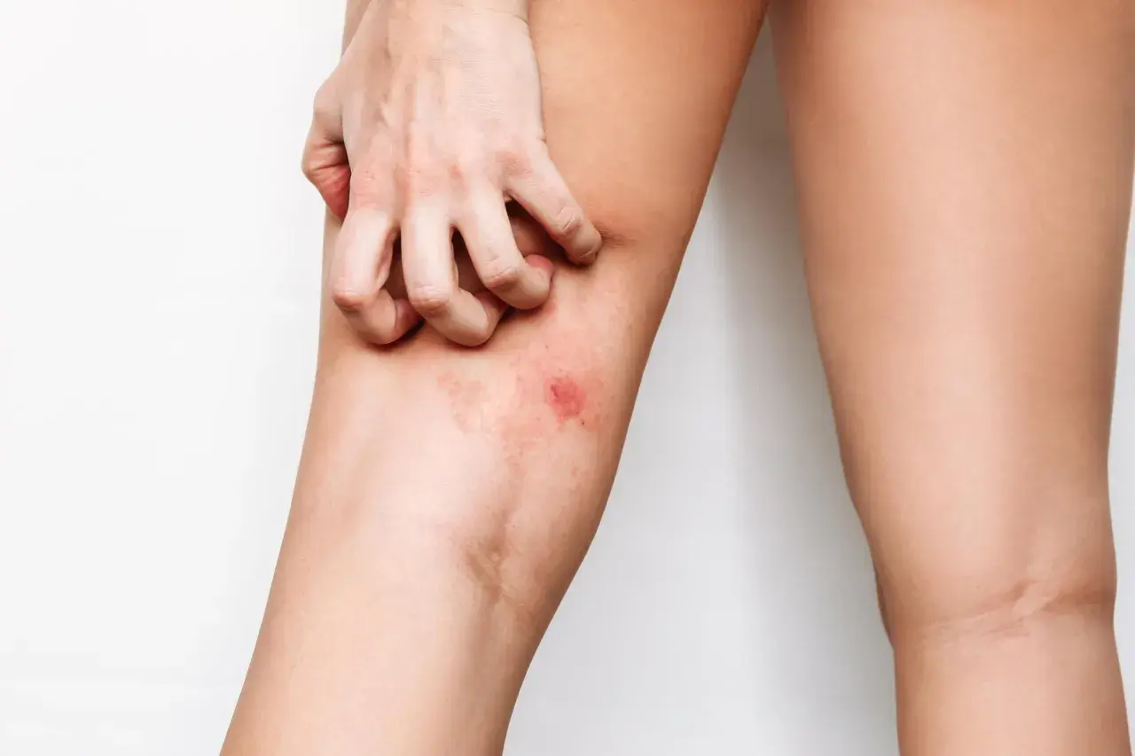 Mano che si gratta la coscia irritata, cercando rimedi naturali per lo sfregamento cosce.