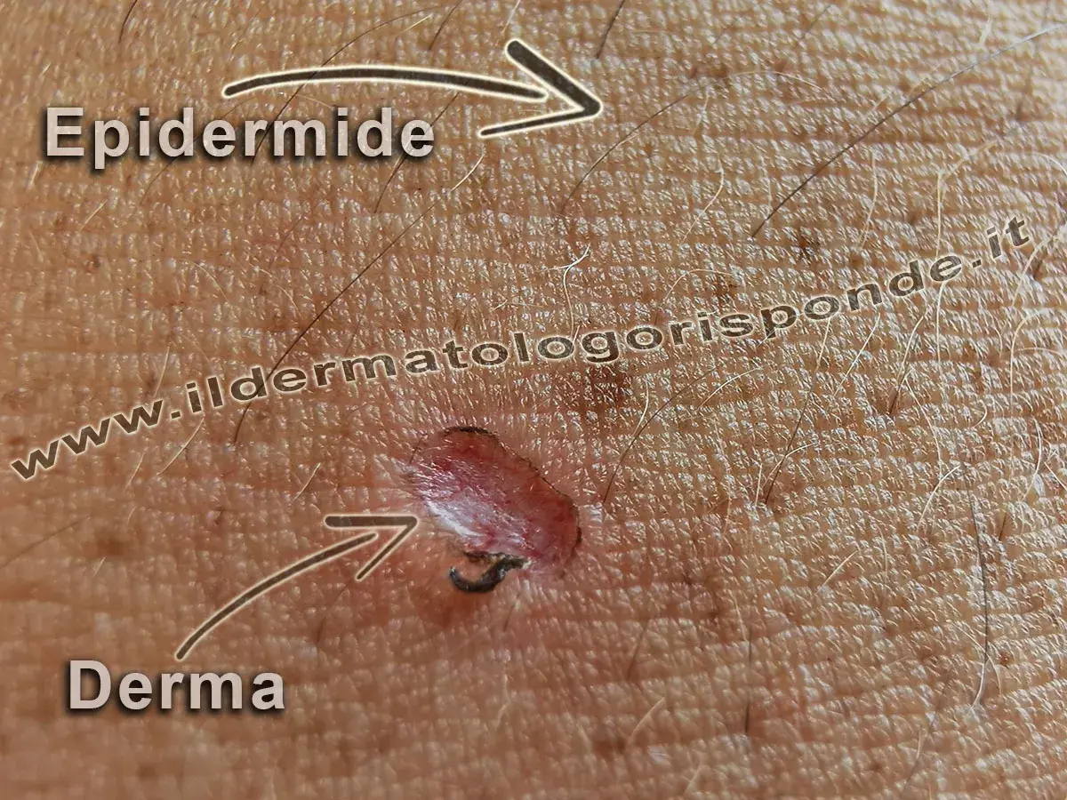 Ingrandimento della pelle che mostra l'epidermide superficiale e la derma sottostante, con una piccola lesione.