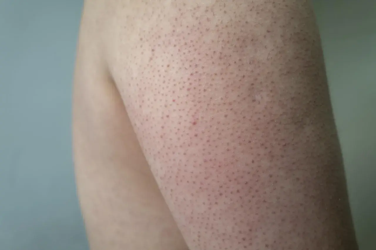 Pelle con follicolite alle gambe, piccoli puntini rossi e peli incarniti. Scopri come curarla per una pelle liscia e sana.