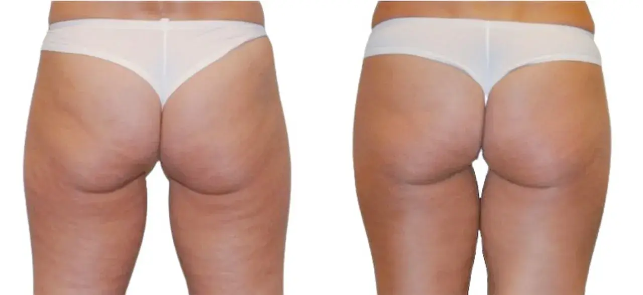 Confronto radiofrequenza glutei prima e dopo: pelle più liscia e tonica.