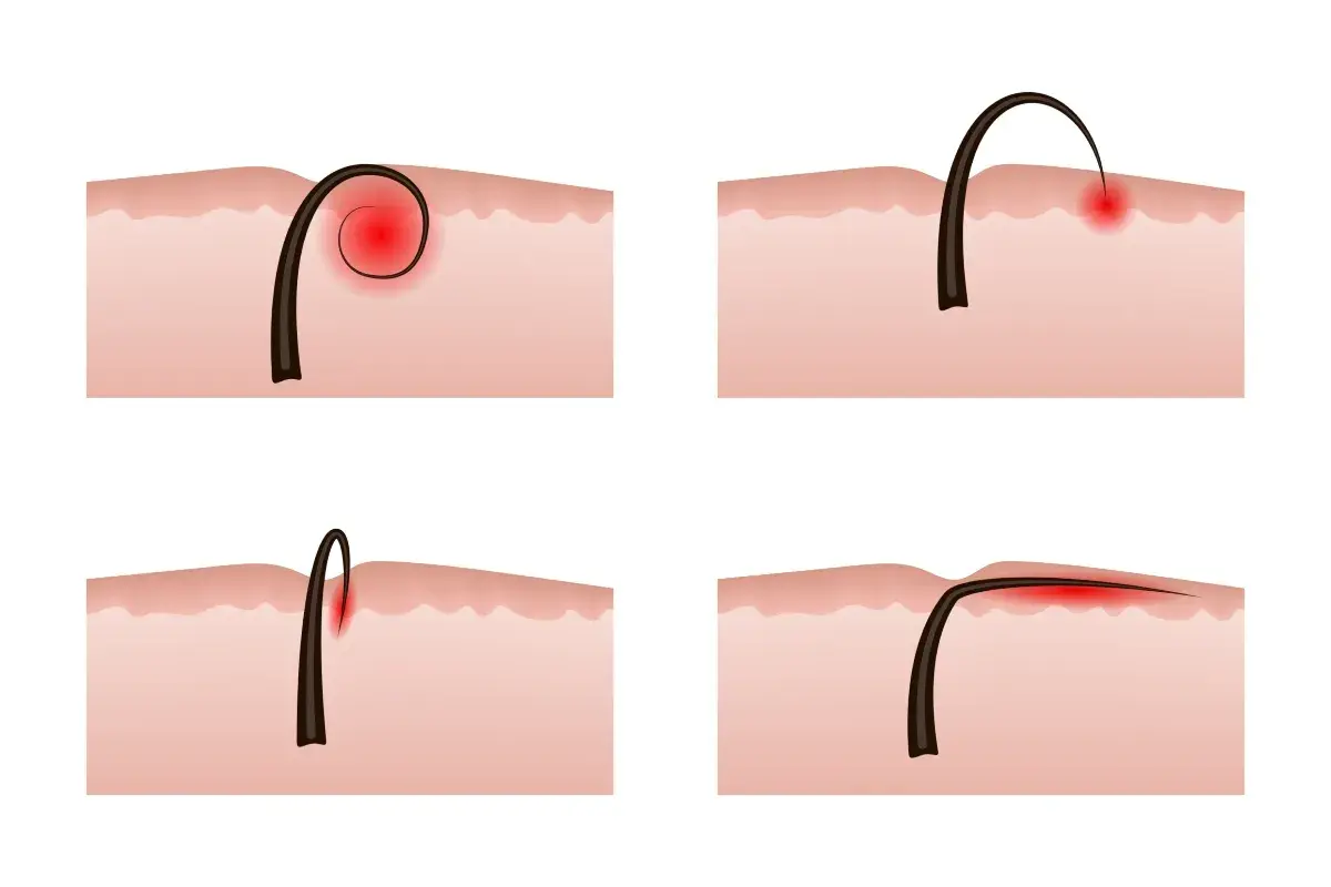Illustrazione di peli incarniti e infezione cutanea. Diverse fasi di un pelo che cresce sotto la pelle, causando infiammazione e rossore.