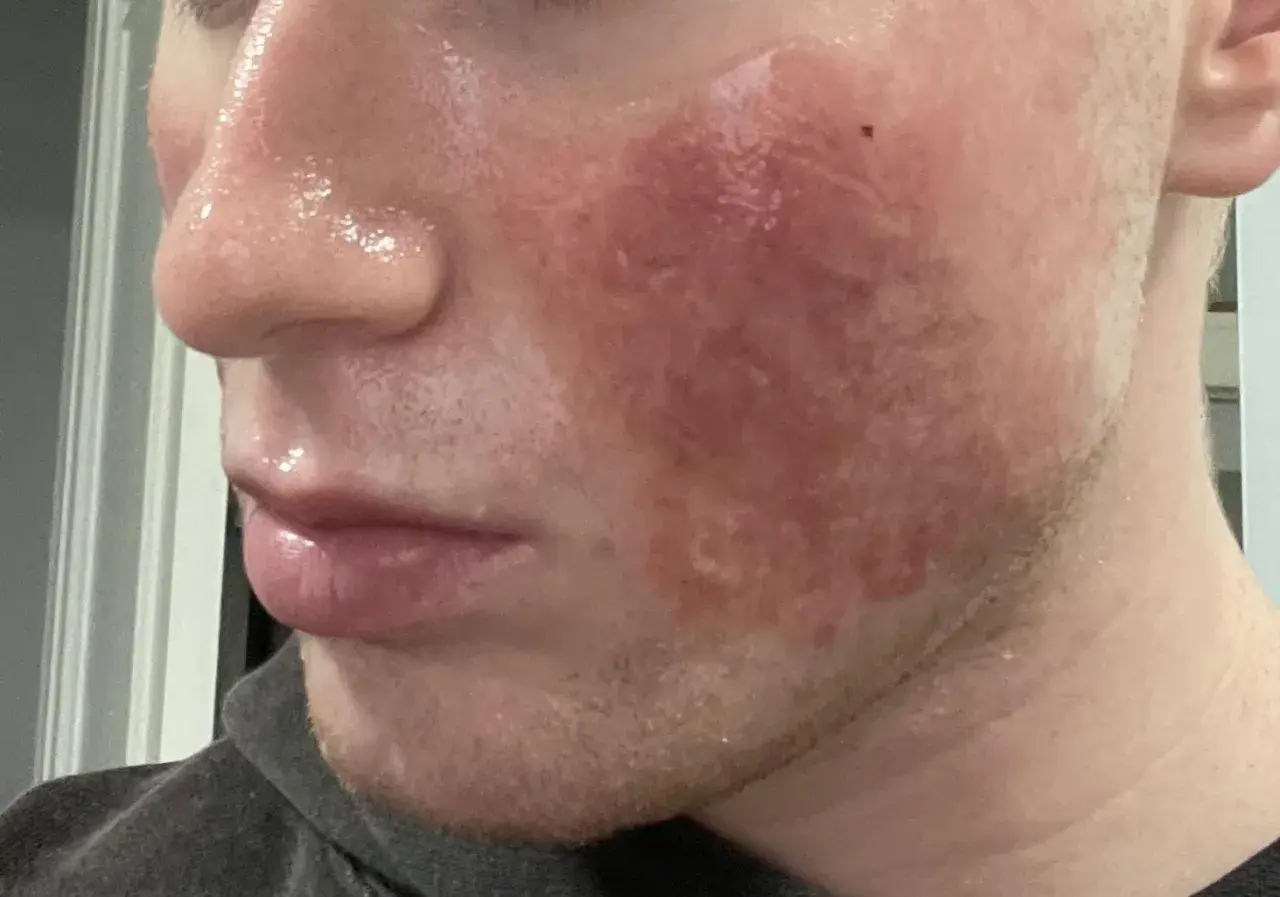 Viso con rossore intenso e pelle lucida dopo trattamento laser CO2 frazionato.
