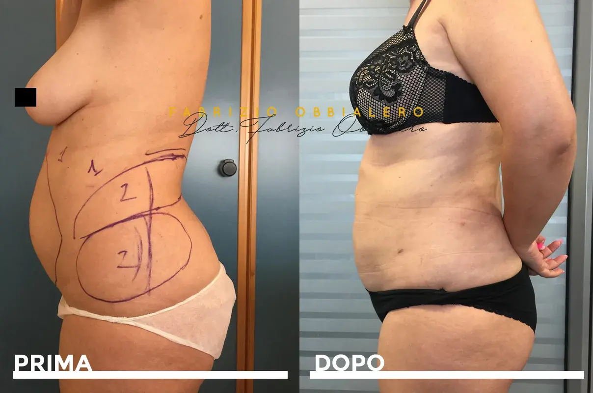 Carbossiterapia pancia prima e dopo: confronto visivo dei risultati. La foto mostra una trasformazione della silhouette.