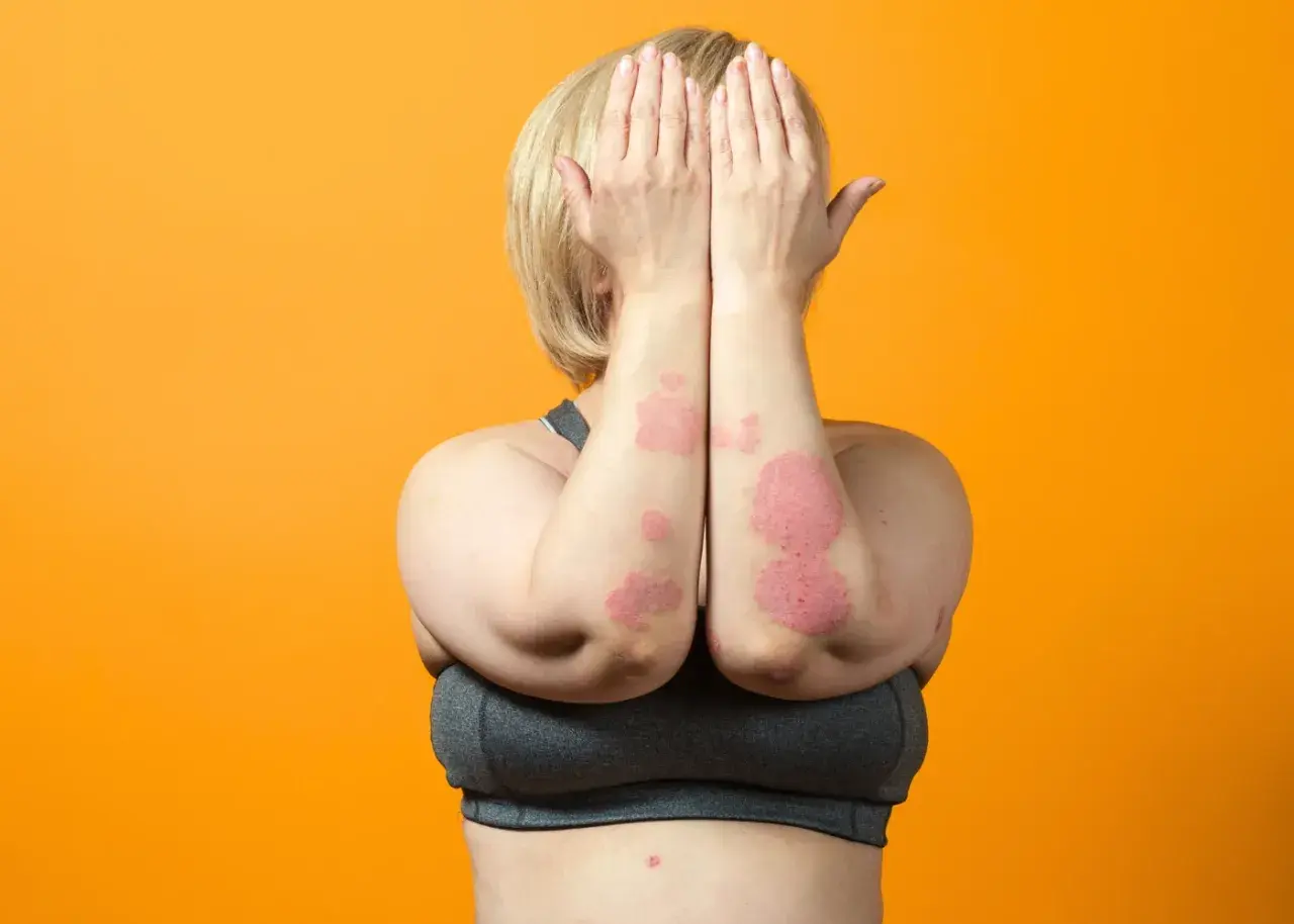 Donna con chiazze rosse sulle braccia, segno di psoriasi da stress. Copre il viso con le mani.