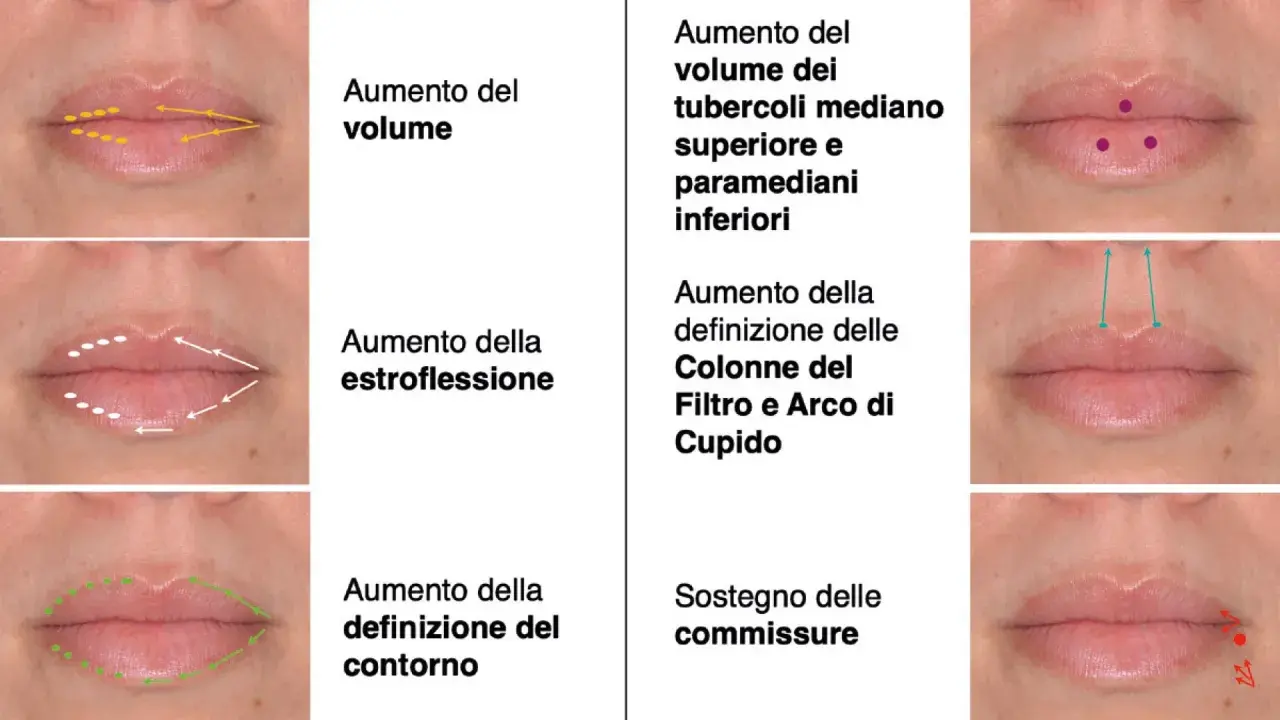Esempi di filler labbra fatto male: labbra gonfie, asimmetriche o con contorni innaturali. Illustrazioni mostrano correzioni.