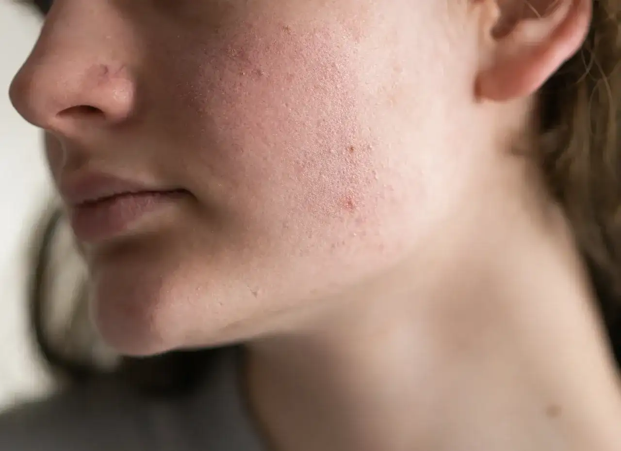 Primo piano del viso di una persona con rossori e imperfezioni, indicativi di una barriera cutanea danneggiata.