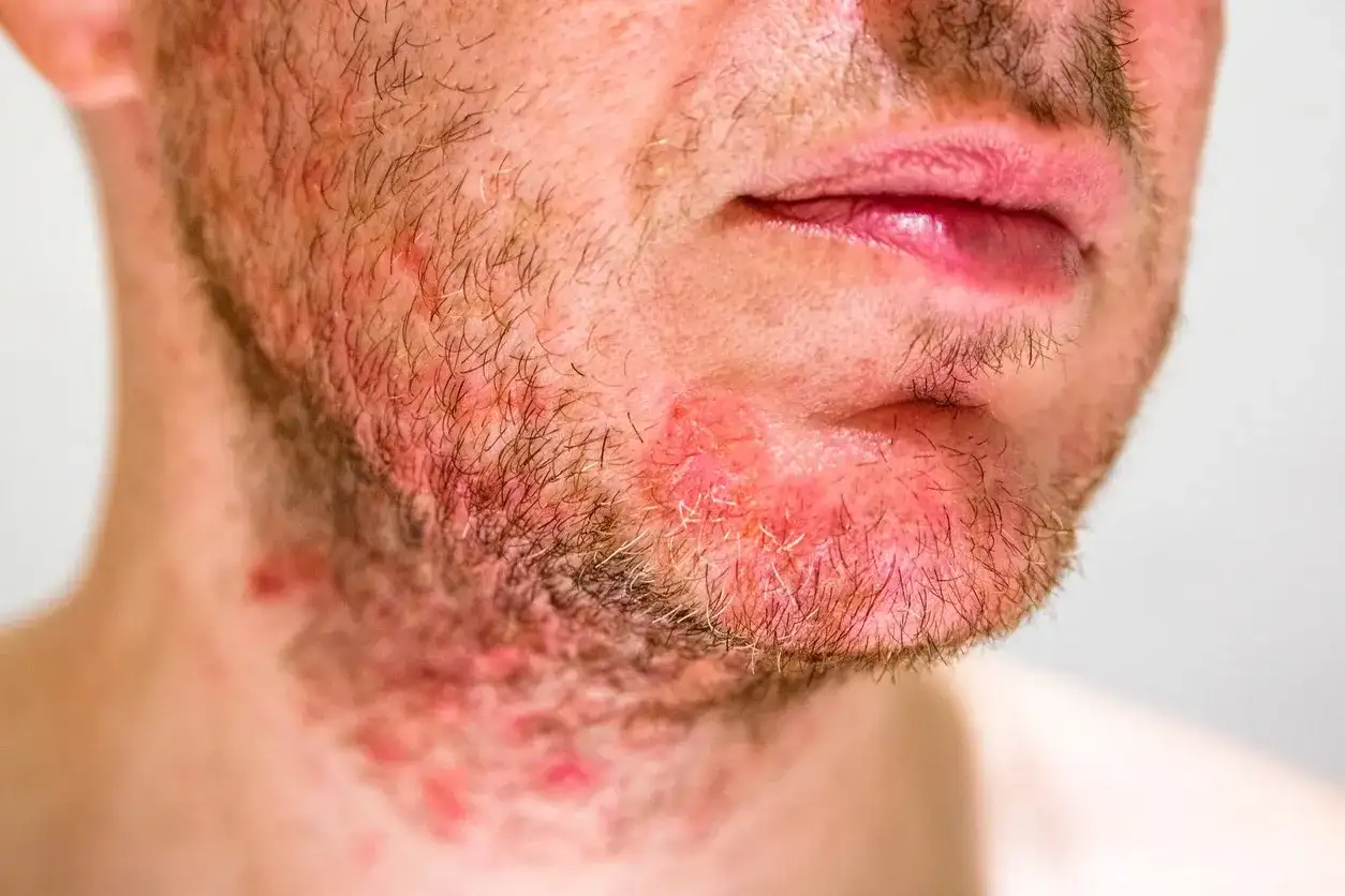 Viso con barba e collo arrossati e irritati, segni di dermatite seborroica.