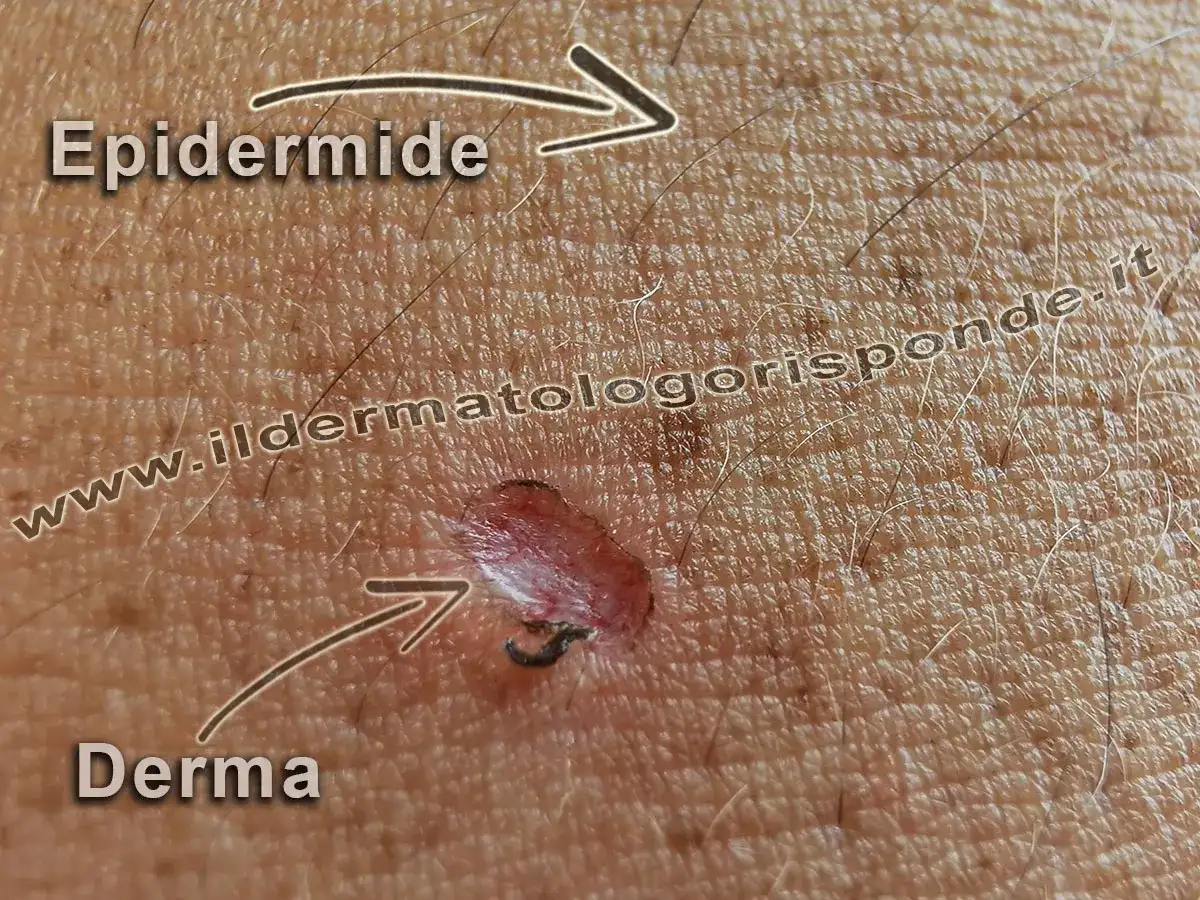 Ingrandimento della pelle che mostra l'epidermide superficiale e la derma sottostante, con una piccola lesione.