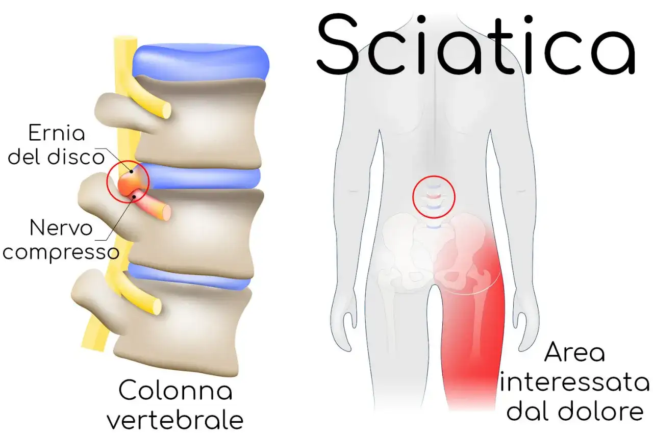 Ernia del disco comprime il nervo sciatico, causando dolore alla gamba. Illustrazione medica.