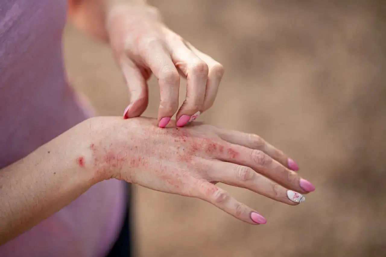 Mani con eritema e prurito, segni di dermatite da contatto.