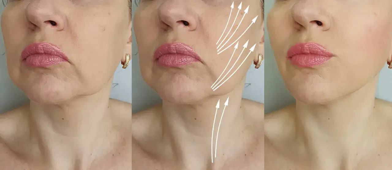 Prima e dopo: la pelle del viso e del collo mostra i segni del tempo, con guance cadenti. Le frecce indicano i possibili rimedi per un effetto lifting.