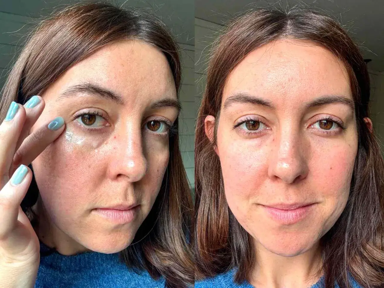 Donna applica crema contorno occhi. L'occhio sinistro appare leggermente arrossato e con un occhio gonfio sotto, mentre il destro &egrave; pi&ugrave; disteso.