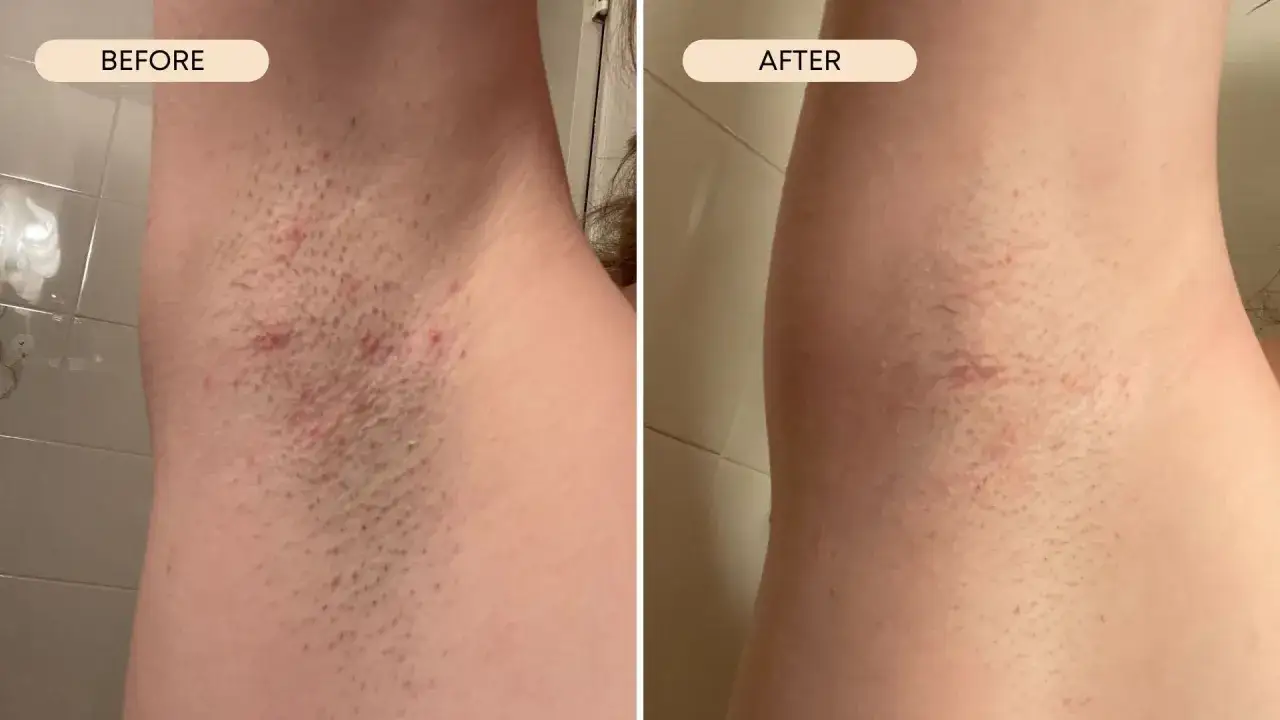 Ascella con irritazione e peli incarniti prima del trattamento, e dopo, con pelle pi&ugrave; liscia e meno rossore.