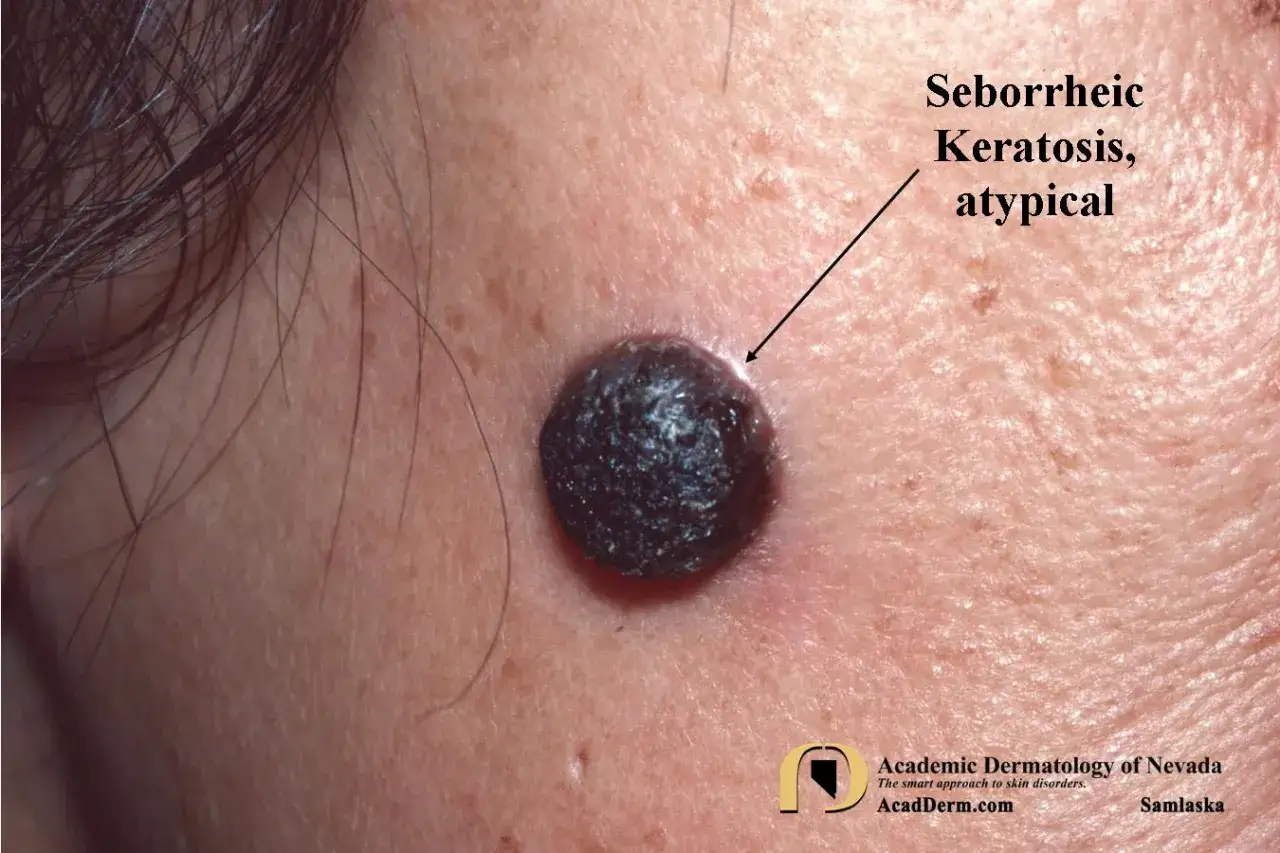Cheratosi seborroica atipica, una lesione cutanea scura e ruvida sulla pelle.