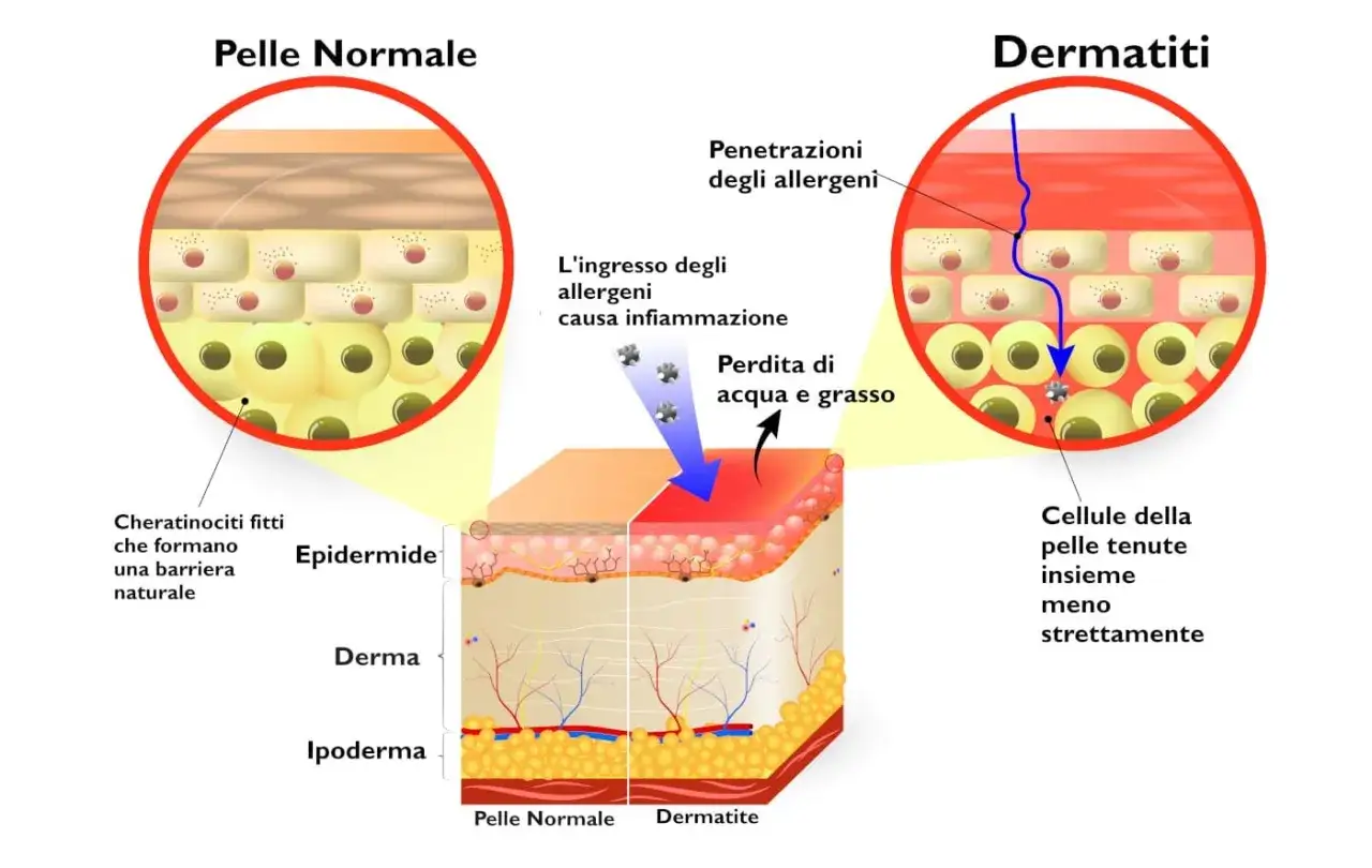 Confronto tra pelle normale e dermatite: la pelle sana ha cheratinociti fitti, mentre la dermatite mostra penetrazione di allergeni, infiammazione e perdita di acqua e grasso.